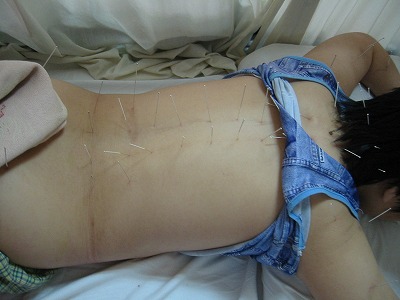 痿証（筋萎縮性側索硬化症、ALS）