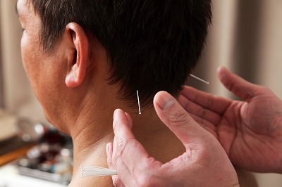 醒脳開竅針刺法による脳梗塞後遺症の鍼灸治療
