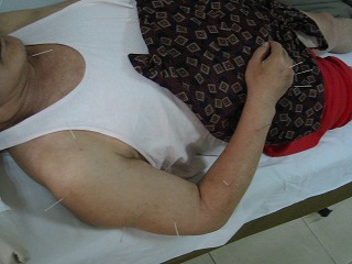 脳梗塞後遺症患者への醒脳開竅針刺法