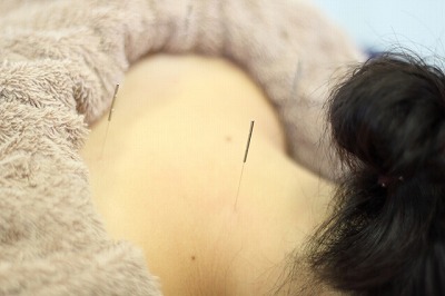 鍼灸治療