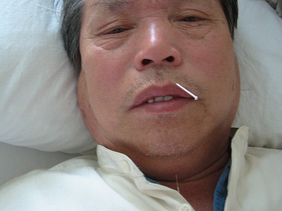 醒脳開竅針刺法