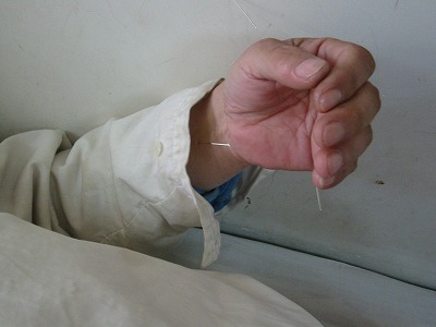 醒脳開竅針刺法