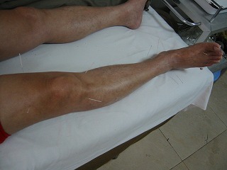 脳梗塞後遺症患者への醒脳開竅針刺法